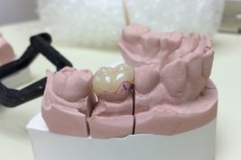 porcelain onlays
